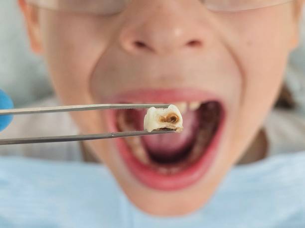 Best Emergency Root Canal Treatment in Comer, GA